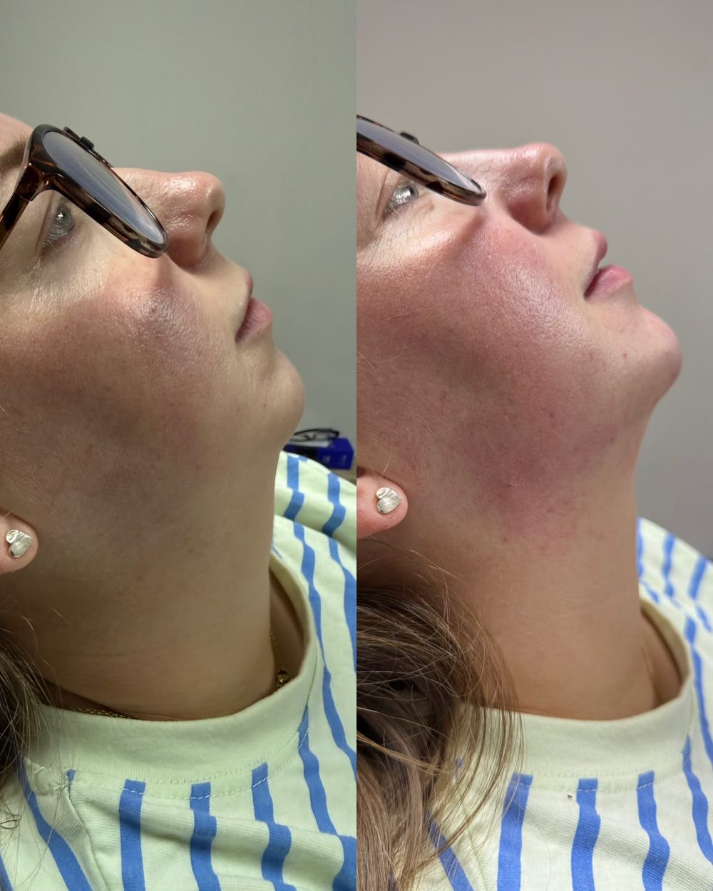 Before and after facial balancing at Her Haus Aesthetics