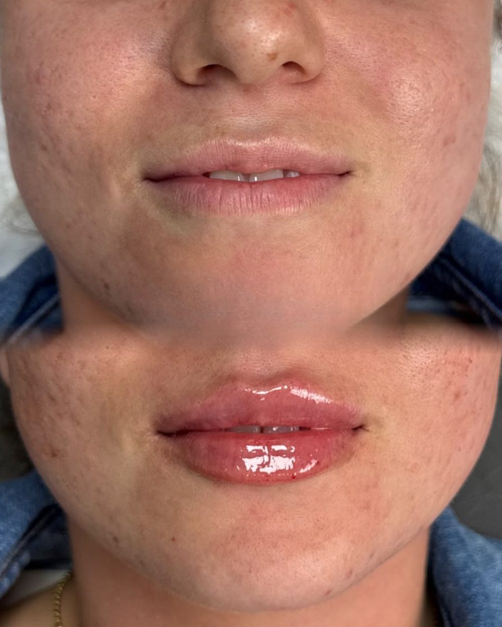 Before and after lip enhancement at Her Haus Aesthetics