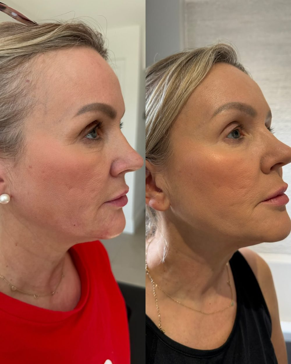 Before and after jawline treatment at Her Haus Aesthetics