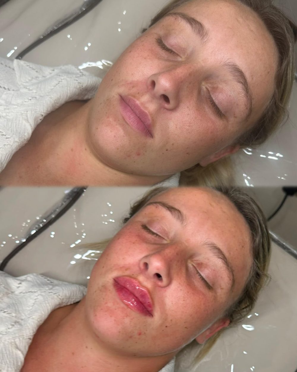 Before and after treatment at Her Haus Aesthetics